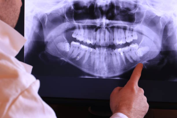 Best Emergency Wisdom Tooth Extraction in Perry, KS